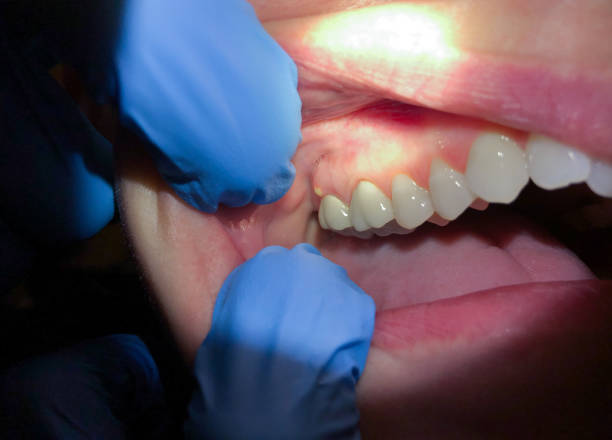 Best Emergency Dental Care for Sports Injuries in Polo, IL